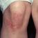 Gatal-gatal di bawah lutut pada selekoh, rawatan gatal-gatal di bahagian dalam lutut