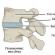 Bagaimana untuk menyembuhkan hernia cakera intervertebral