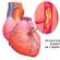 Атеросклероз коронарных артерий Атеросклероз сосудов сердца консервативное лечение